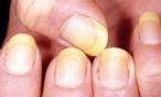 أسباب لإصفرار الاظافر يجهلها الكثيرون