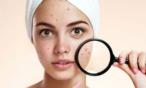 بثور الوجه.. تخبرك بنوع مرضك