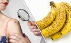 بشرى سارة: البقع السوداء على الموز تسهم في علاج هذا المرض الشهير